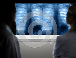 Doctors diagnosing lung cancer from x-ray photo