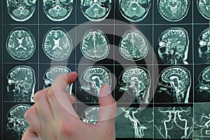Doctors hand pointing to mri image
