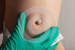 Doctors hands in green medical gloves examine an umbilical hernia in a child, close-up. photo