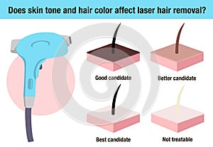 Does skin tone and hair color affect laser hair removal. Hair removal laser icon vector illustration. Flat vector hair