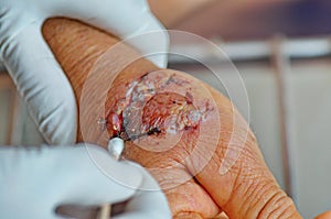 Dog bite injury wound infection