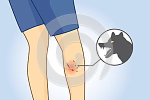 Dog bite wounds on calf leg.