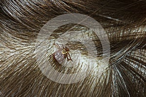 a dog tick attached to hairy scalp of a person