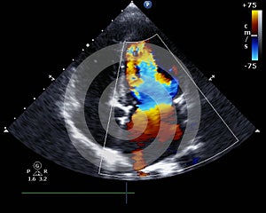 Doppler echocardiography