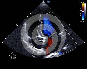 Doppler echocardiography