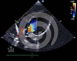 Doppler echocardiography