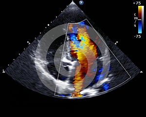 Doppler echocardiography