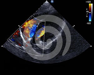 Doppler echocardiography