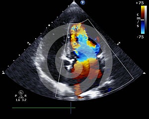 Doppler echocardiography photo
