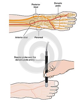 Doppler probe measurement of pedal pulse