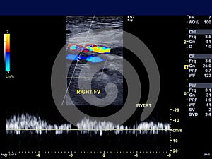 Doppler ultrasound for diagnosis DVT.