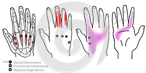 Dorsal interosseous myofascial trigger points and hand pain