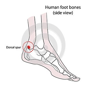 Dorsal spur calcaneal spur. Human foot bones. illustration Isolated on a white background photo