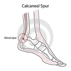 Dorsal spur calcaneal spur. Human foot bones.  illustration Isolated on a white background photo