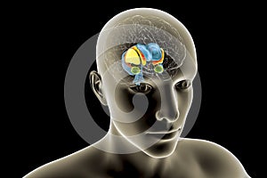 Dorsal striatum and lateral ventricles in the brain of a person with Huntington's disease, 3D illustration