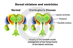 Dorsal striatum and lateral ventricles normal and in Huntington's disease