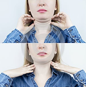 Double chin lift in women. Photos before and after plastic surgery, genioplasty or facebuilding.