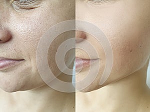 Double chin in women before and after treatment