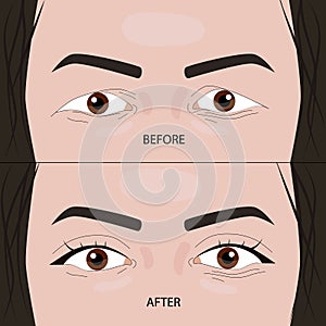 Double eyelid surgery before and after illustration