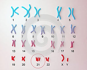 Down-syndrome karyotype