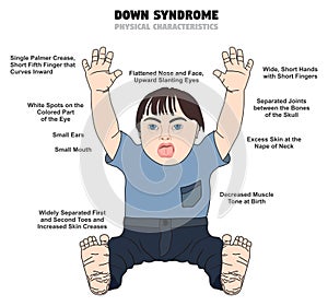 Down syndrome physical characteristic infographic diagram