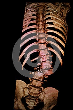 Dramatic spine, ribs fracture. CT-scan reconstruction.