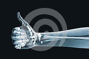 Dramatized x ray of a hand thumbs up