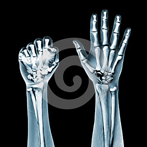 Dramatized x ray of two hands on black