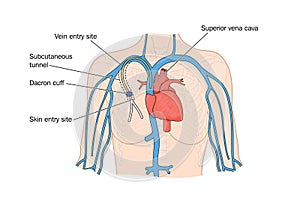 Drawing of catheter insertion into heart photo