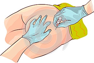 Drawing of Gloved hands aspirating syringe at dorsogluteal site of injection