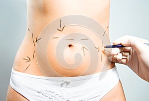 Drawing marks for abdominal plastic surgery