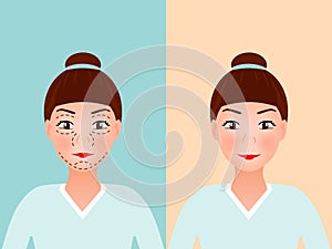 Drawing perforation lines on young pretty woman`s face for plastic surgery. Before and after procedure. vector