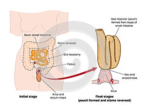 Drawing of rectal pouch after bowel removal