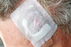 Dre of a lentigo maligna, melanoma in situ on the forehead of a 64 year old man photo