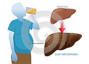 Drink alcohol make a big belly which that was the Cirrhosis.