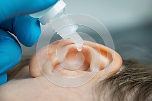 dripping ear drops into patient ear. ear pain and clogged ears concept