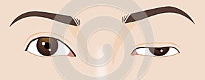 Droopy eyelid ptosis, blepharoplasty symptom, myasthenia gravis, illustration