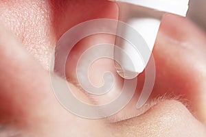 A drop of ear medicine falls into the child`s ear close-up