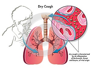 Dry cough