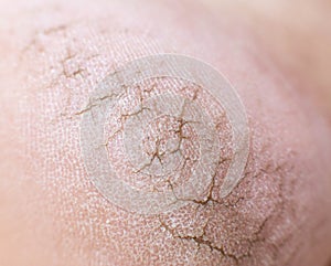 Dry cracked skin on the heels of a person s legs, close-up. Concept of serious skin diseases and fungal infection, macro