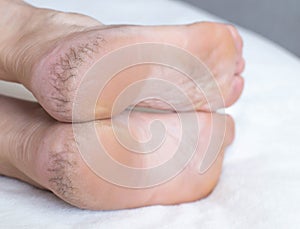 Dry cracked skin on the heels of a person s legs, close-up. The concept of serious skin diseases and kidney failure