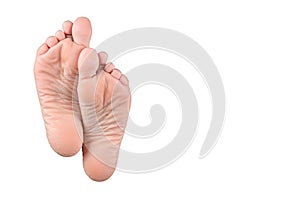 Dry and cracked soles of feet on white background. Dry heels and soles woman on closeup. dry skin on heels and soles needs care.