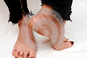 Dry and cracked soles of feet. Womans feet with dry heels, cracked skin.White background