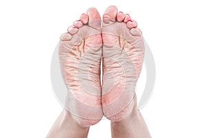 Dry dehydrated skin on the heels of female feet with calluses