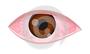 Dry eye syndrome. Inflamed bloodshot eyeball with swelling, irritation and red conjunctiva. Symptoms of infection