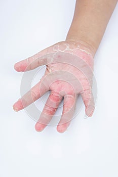 Dry hands, peel, Contact dermatitis, fungal infections, Skin inf