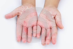 THE Dry hands, peel, Contact dermatitis, fungal infections, Skin inf