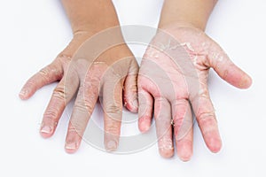 Dry hands, peel, Contact dermatitis, fungal infections, Skin inf