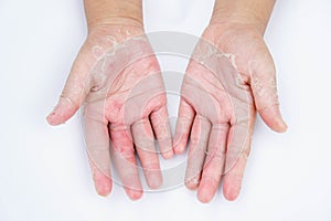 The Dry hands, peel, Contact dermatitis, fungal infections, Skin inf