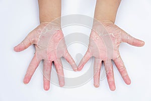 The Dry hands, peel, Contact dermatitis, fungal infections, Skin inf